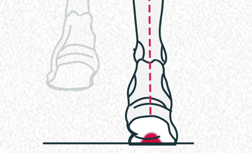 Pronation Corrected by correct footwear natterjack running